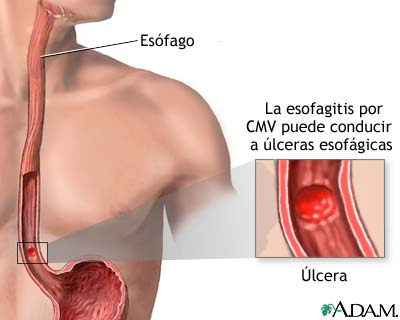 Esofagitis por CMV