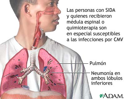 Neumon&iacute;a por CMV