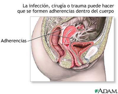 Adherencias p&eacute;lvicas