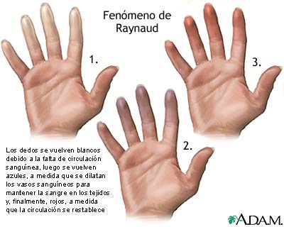 Fen&oacute;meno de Raynaud
