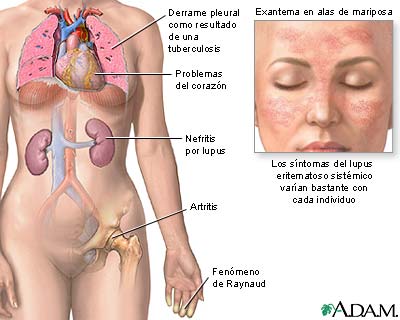 Lupus eritematoso sist&eacute;mico