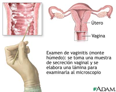 Prueba de vaginitis (montaje h&uacute;medo)