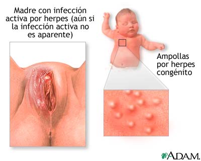 Herpes cong&eacute;nito