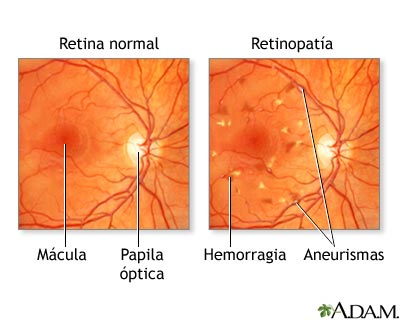 Retinopat&iacute;a diab&eacute;tica