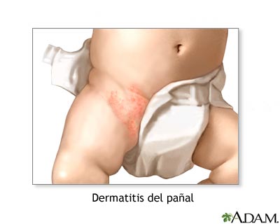 Sarpullido del pa&ntilde;al