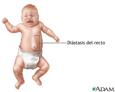 Di&aacute;stasis del recto