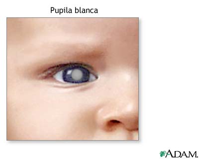 Manchas blancas en la pupila