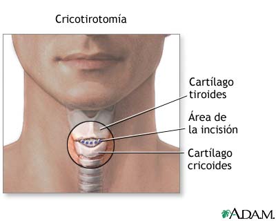 Punci&oacute;n de emergencia del conducto de aire