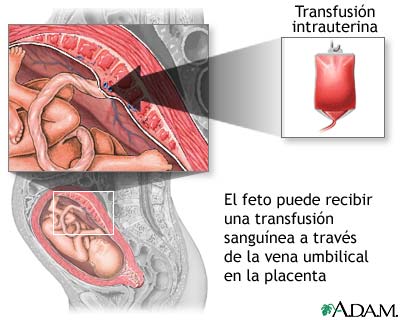 Transfusi&oacute;n intrauterina