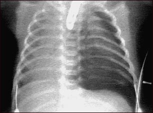 Neumot&oacute;rax, radiograf&iacute;a de t&oacute;rax