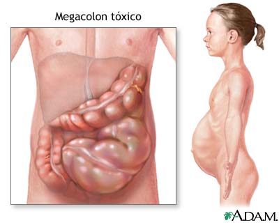 Megacolon t&oacute;xico