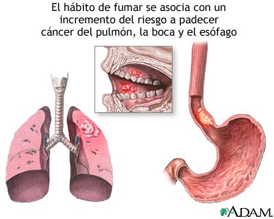 Tabaco y c&aacute;ncer