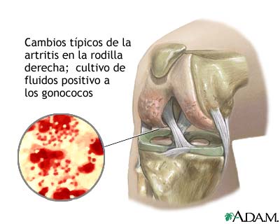 Artritis gonoc&oacute;cica