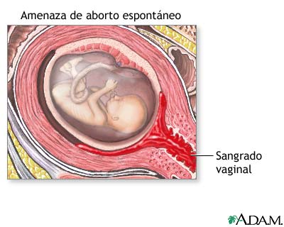 Aborto espont&aacute;neo