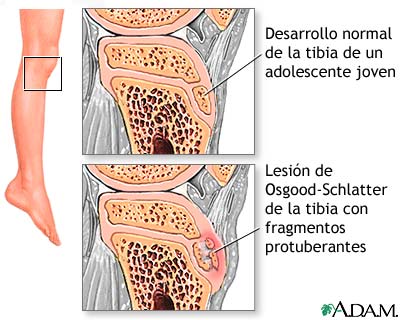 Dolor de pierna (lesi&oacute;n de Osgood-Schlatter)