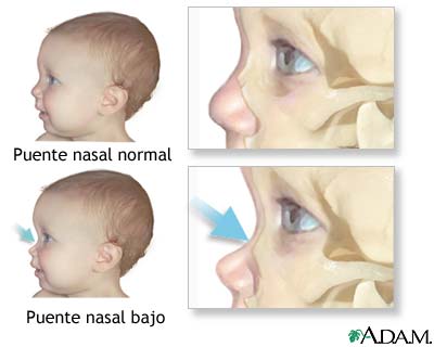 Puente nasal bajo