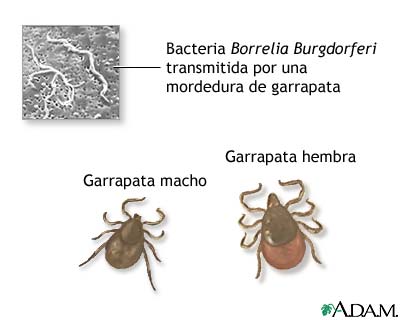 Enfermedad de Lyme terciaria