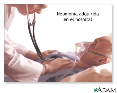 Neumon&iacute;a adquirida en el hospital