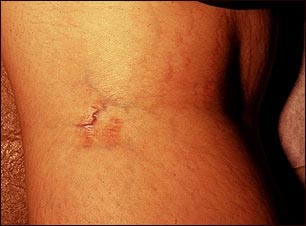 Estr&iacute;a en la fosa popl&iacute;tea