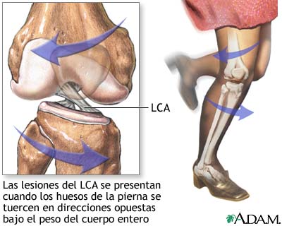 Lesi&oacute;n del LCA