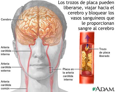 Aterosclerosis de la arteria car&oacute;tida interna