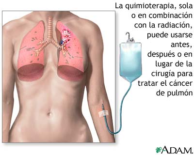 Tratamiento con quimioterapia para c&aacute;ncer pulmonar