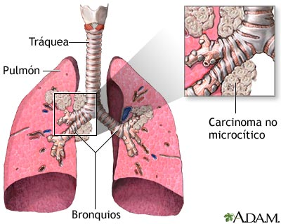 Carcinoma de c&eacute;lulas grandes