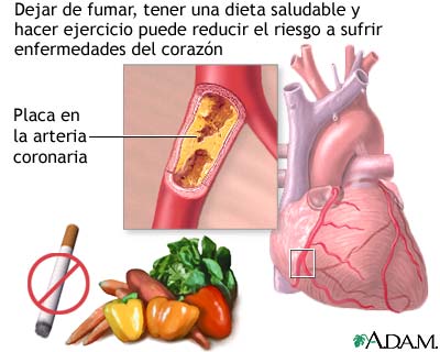 Prevenci&oacute;n de la enfermedad card&iacute;aca