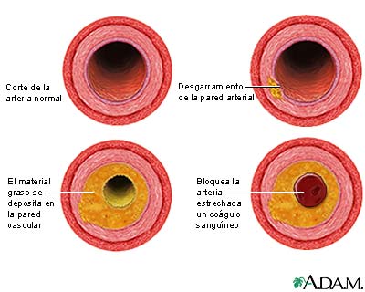 Proceso de evoluci&oacute;n de la aterosclerosis