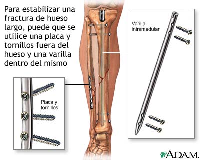 Dispositivos de fijaci&oacute;n interna