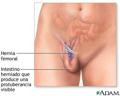 Hernia femoral