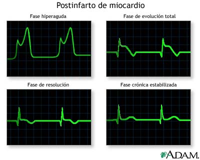 Gr&aacute;ficos de las ondas del ECG despu&eacute;s del infarto al miocardio