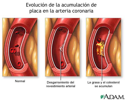 Acumulaci&oacute;n progresiva de placa en arteria coronaria