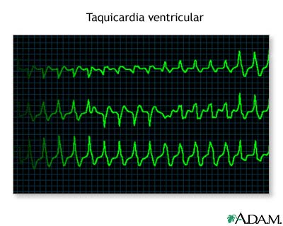 Taquicardia ventricular