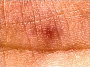 Vista de cerca de la lesi&oacute;n de Janeway