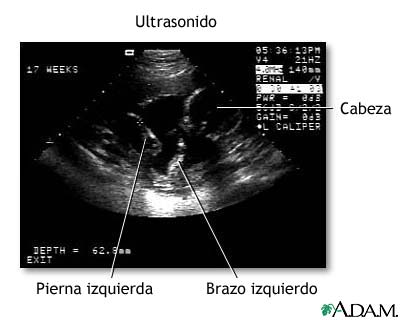 Ultrasonido de los ventr&iacute;culos del cerebro en fetos normales