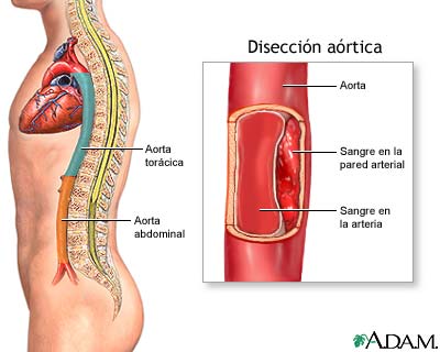 Disecci&oacute;n a&oacute;rtica