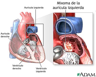 Mixoma de la aur&iacute;cula izquierda