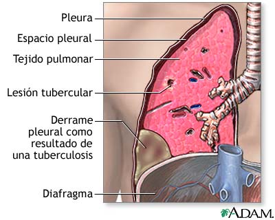 Efusi&oacute;n pleural
