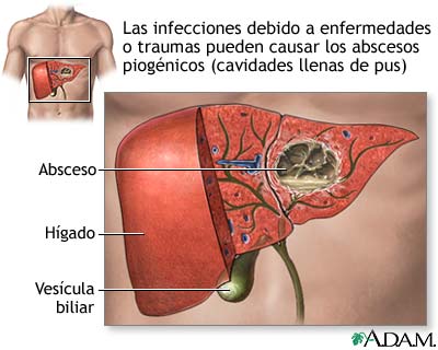 Absceso piog&eacute;nico