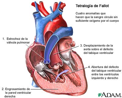 Tetralog&iacute;a de Fallot