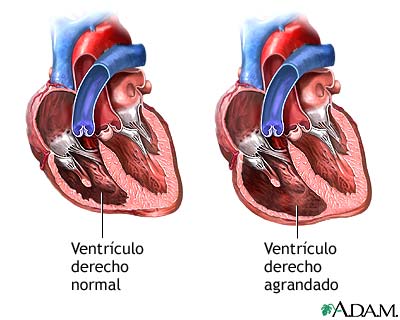Regurgitaci&oacute;n tricusp&iacute;dea