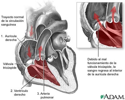 Regurgitaci&oacute;n tricusp&iacute;dea