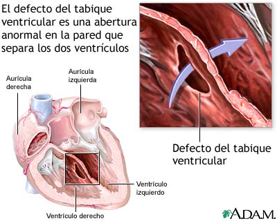 Defecto del tabique ventricular