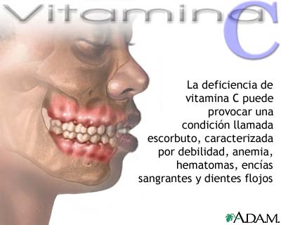 D&eacute;ficit de vitamina C