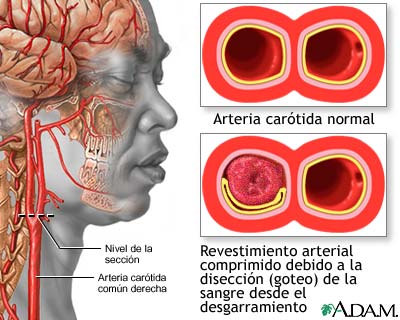 Disecci&oacute;n de la car&oacute;tida
