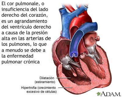 Cor pulmonale