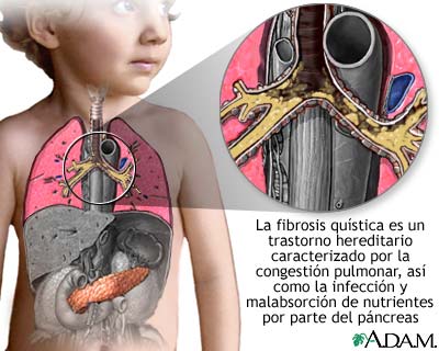 Fibrosis qu&iacute;stica