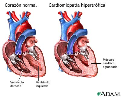 Cardiomiopat&iacute;a hipertr&oacute;fica