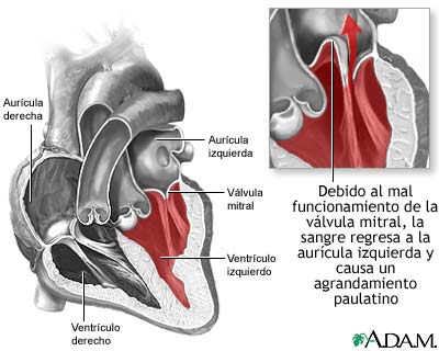 Prolapso de la v&aacute;lvula mitral